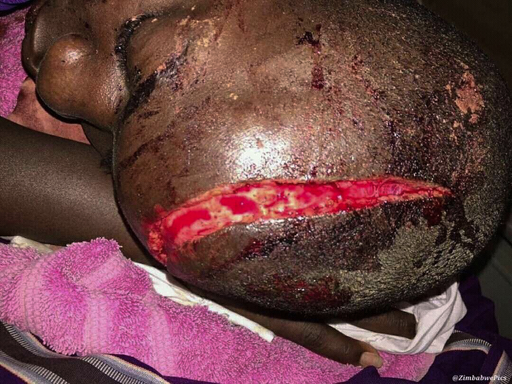 Injured protester in Glen View tonwship Harare September 2016 on www.rhodesian.com.au